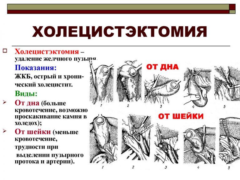 Уход за больными после холецистэктомии
