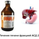 АСД при камнях в желчном пузыре