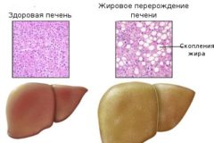 Гепатоз желчного пузыря