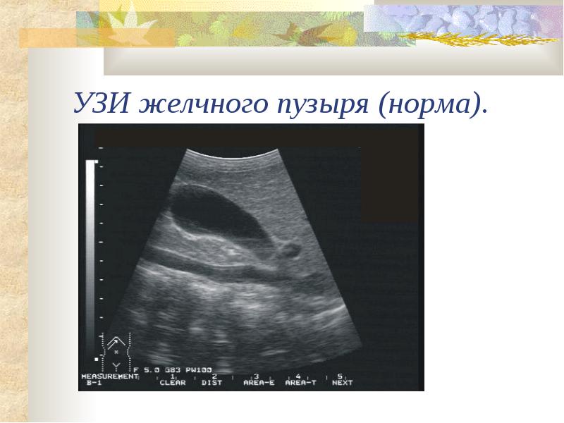 Что такое узи желчного пузыря. Желчный пузырь норма по узи. Эхограмма желчного пузыря. Измерение желчного пузыря узи. Что такое узи желчного пузыря.