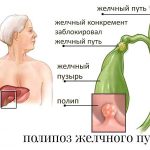 Чистотел о полипов в желчном пузыре