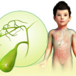 Камни в желчном пузыре у ребенка