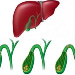 Закупорка камнем в протоке желчного пузыря. Что делать?