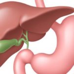 Калькулезный холецистит